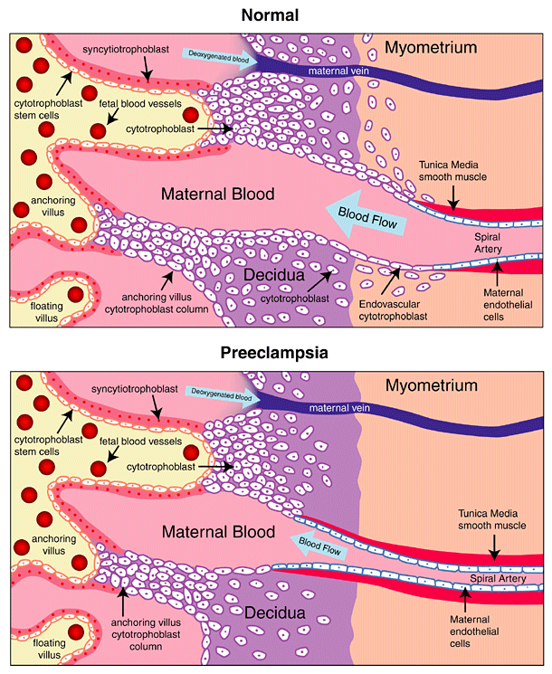 Figure 1: Abnormal placentation in preeclampsia...